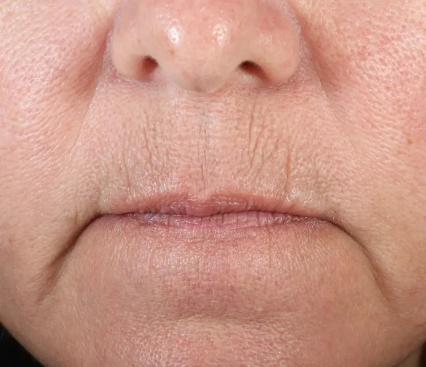 lip area before using Nuface product