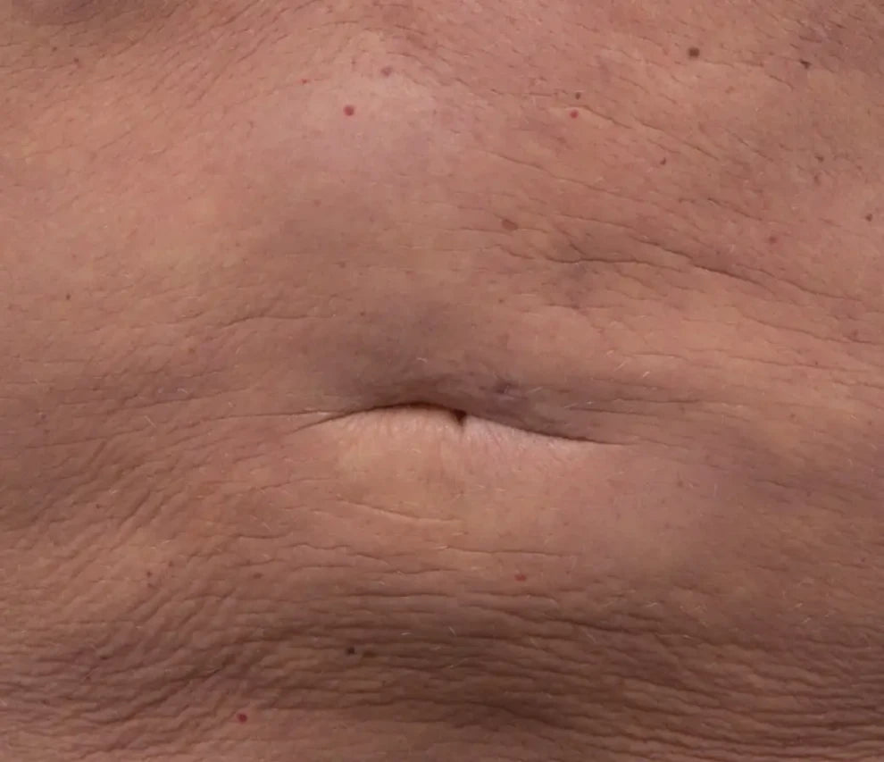 skin before using Nuface product