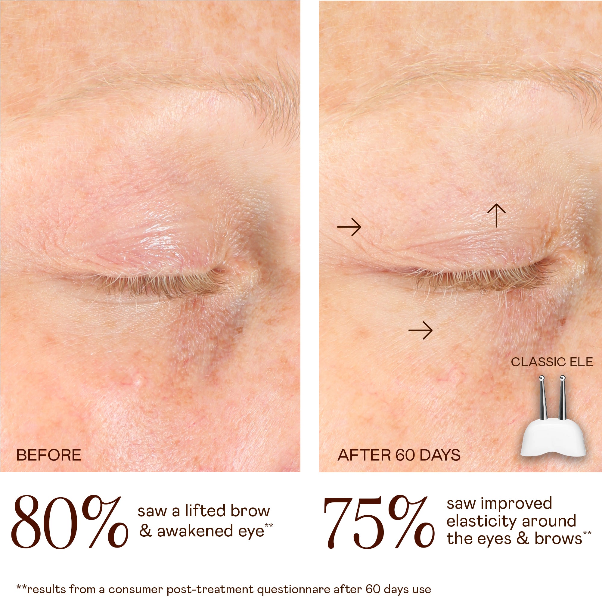 NUFACE Trinity Classic ELE Attachment for Smile Lines & Eye Wrinkles