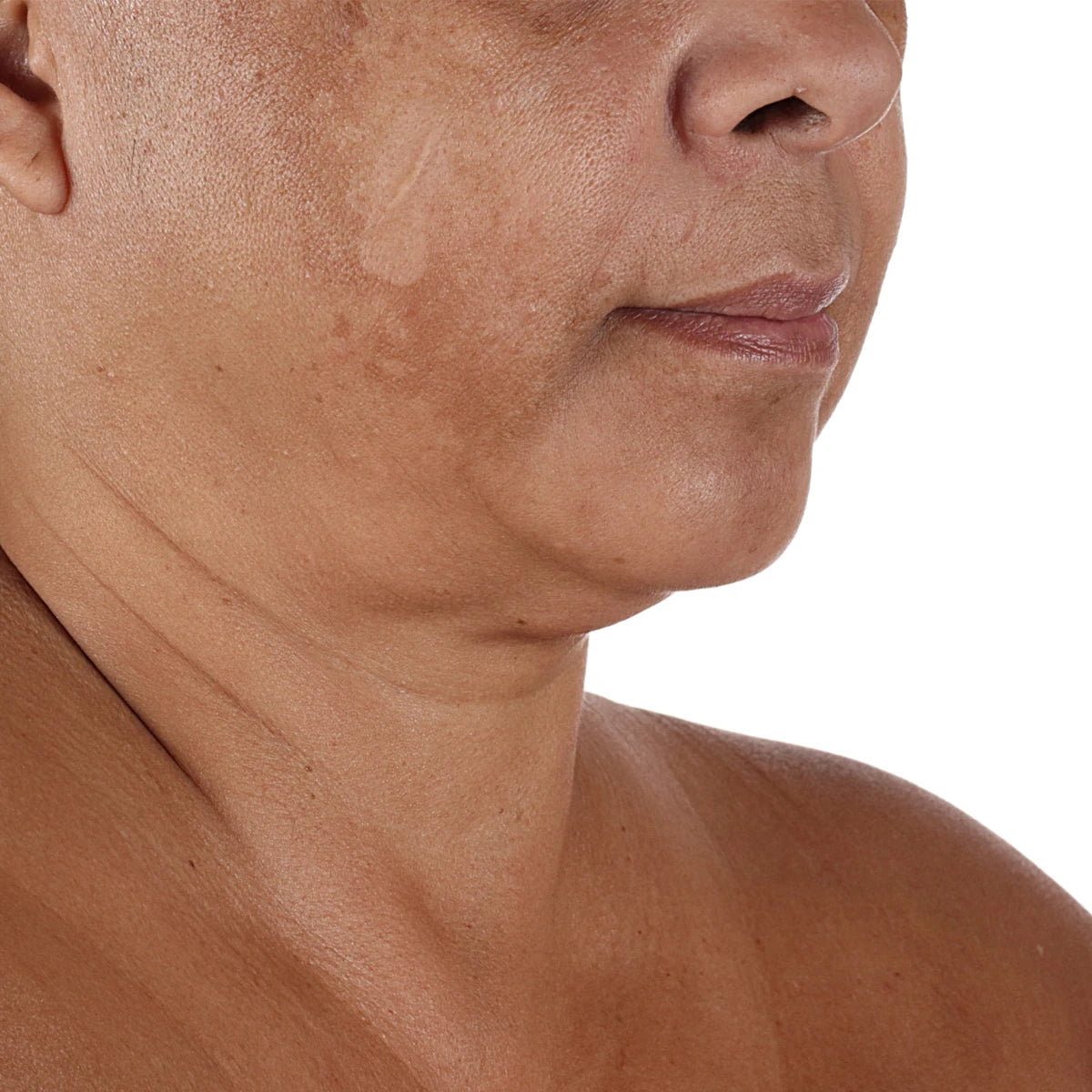jawline skin before using Nuface product