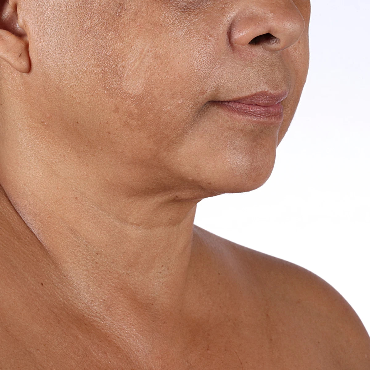 jawline skin after using Nuface product