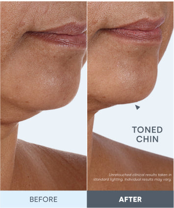 95 Saw Improvement in the Appearance of Sagging Skin Around the Neck