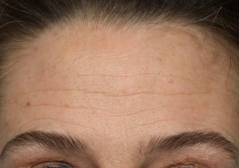 Shot of woman's forehead before using NuFace Trinity