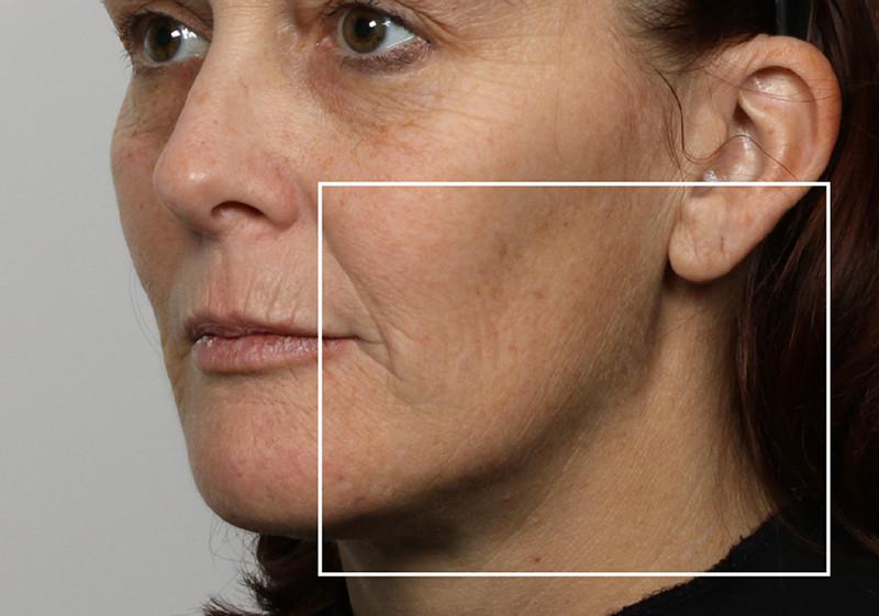 Woman after using NuFace Trinity in 3/4 profile; her jawline is more defined than before