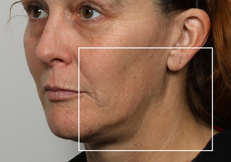 Woman before using NuFace Trinity in 3/4 profile