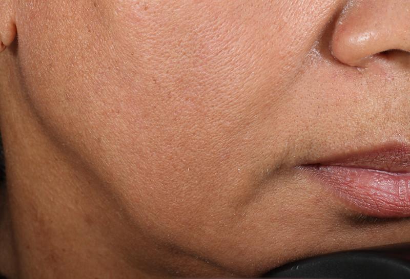 Close shot of woman's jaw after using NuFace Trinity; it is more defined
