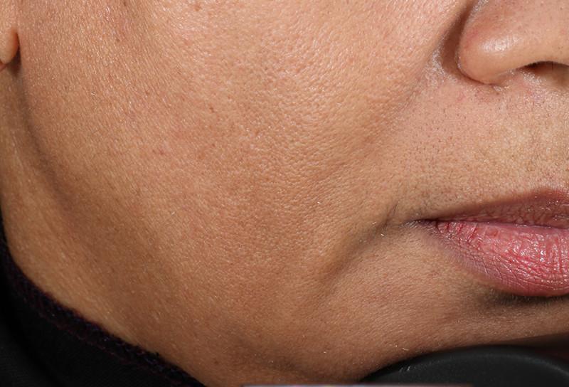 Close shot of woman's jaw before using NuFace Trinity