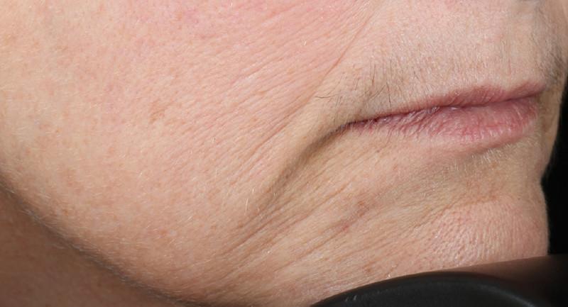 Close shot of woman's chin and mouth after using NuFace Trinity; her wrinkles are less severe.