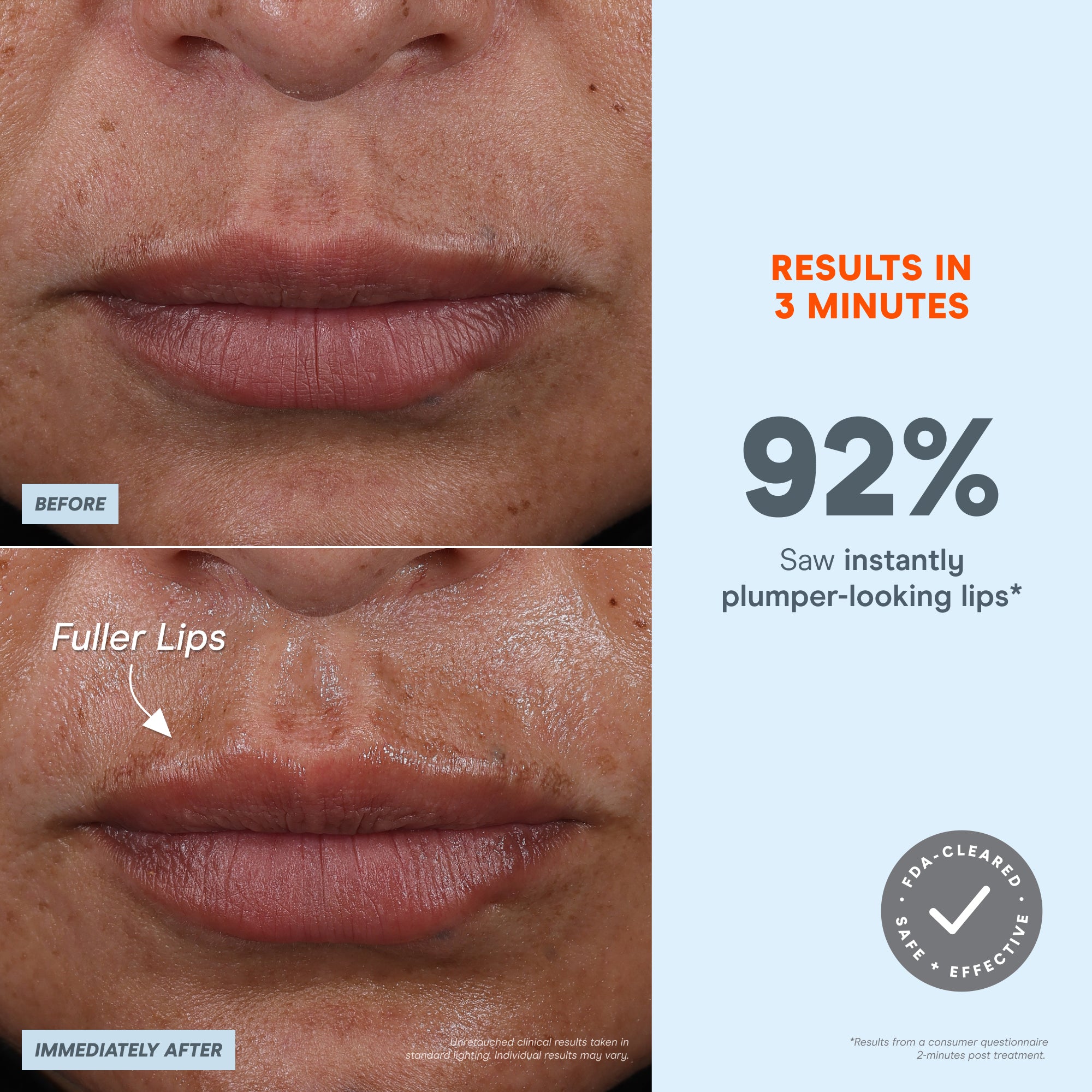 Microcurrent Lip NuFACE FIX MicroWand - Eyes, Lips & Lines Microcurrent Device