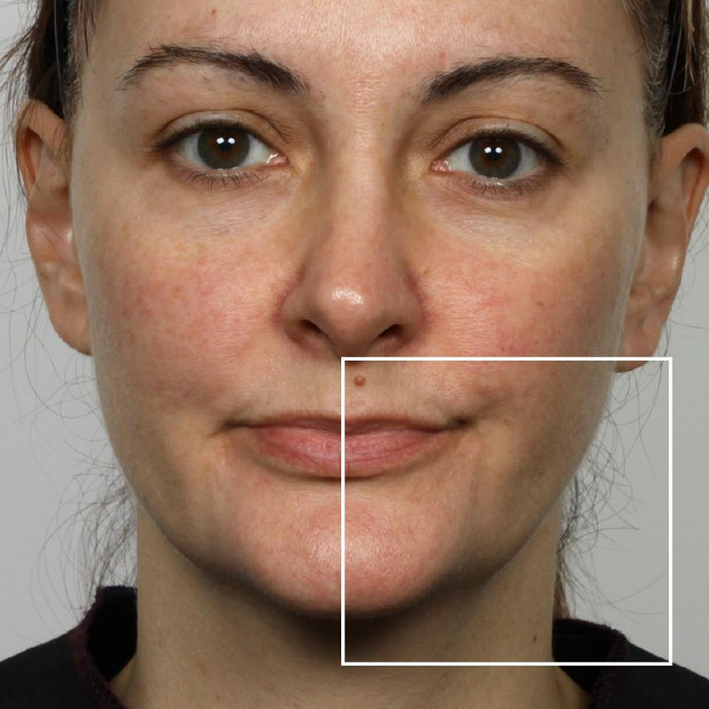 Woman after using NuFace Trinity; her lower cheek and jawline are more defined
