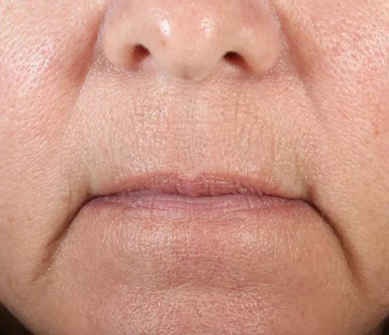 lip area after using Nuface product