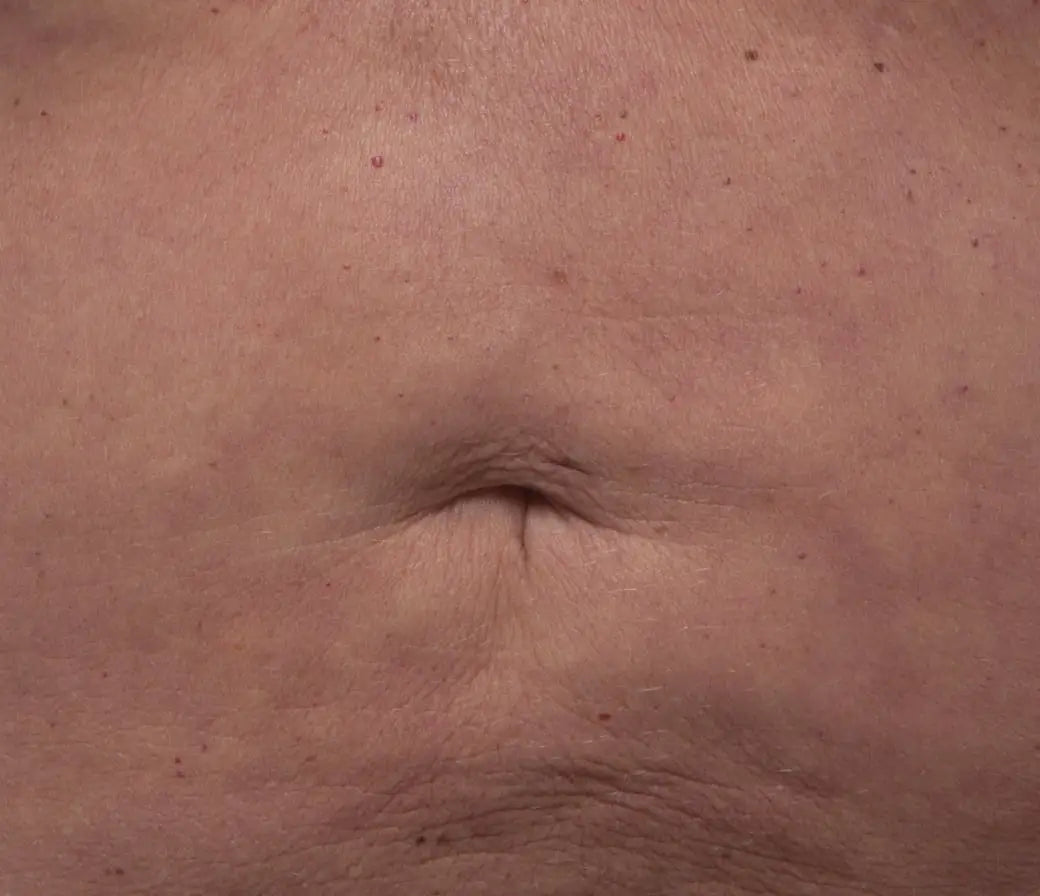 skin after using Nuface product
