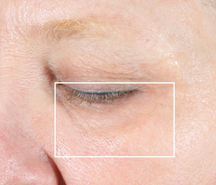 After 3 minutes: undereye area without wrinkles