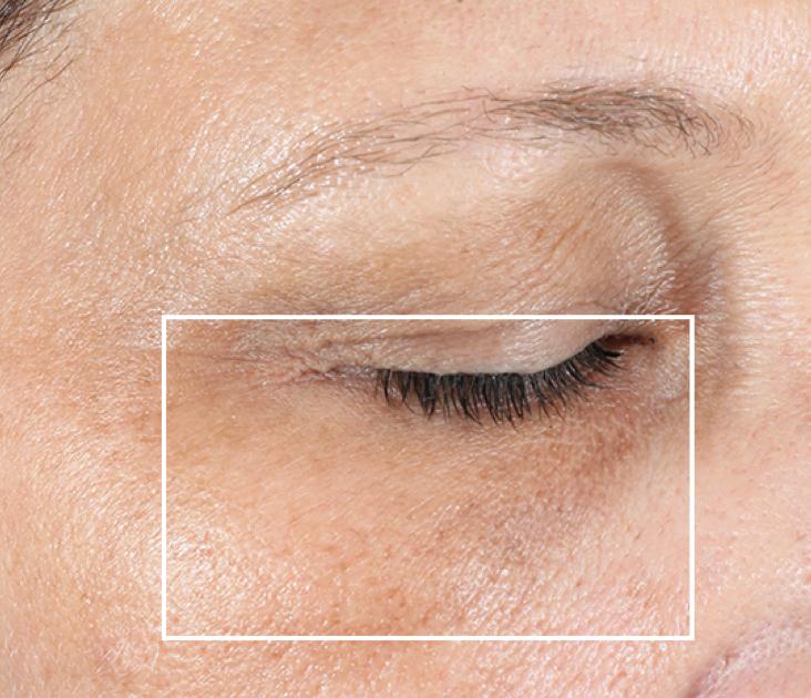 After 3 minutes: undereye area without wrinkles