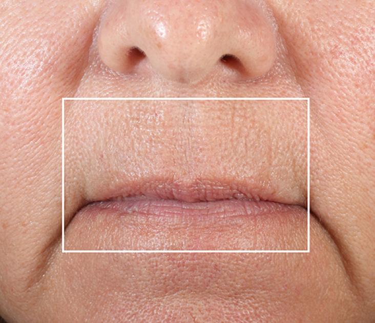 After 6 minutes: Area above lip without wrinkles