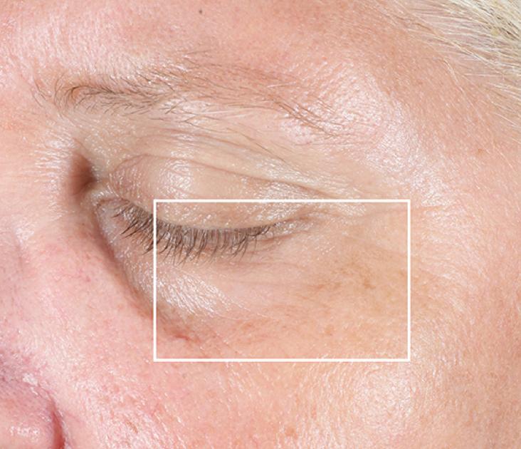 After 3 minutes: undereye area with fewer wrinkles